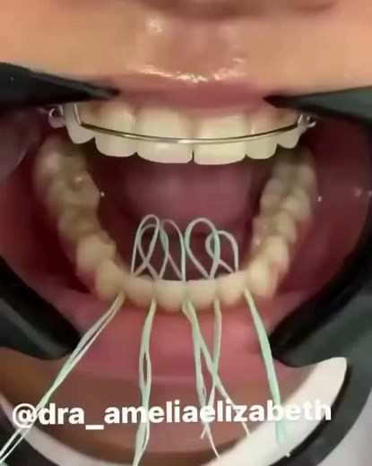 Placing a lingual retainer with floss 🦷by dra_ameliaelizabeth #fyp