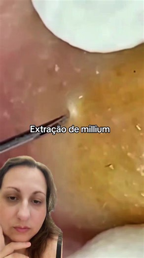 Extração de Millium Satisfatória: Tratamento de Pele