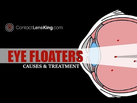 What Causes Floaters in Your Vision and Black Dot in Eye