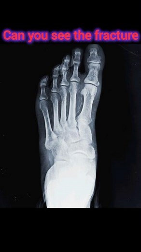 Can you see the fracture