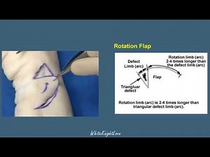8 3 Rotation Flap Skin Flaps Essential Surgical Skills WhiteKnightLove