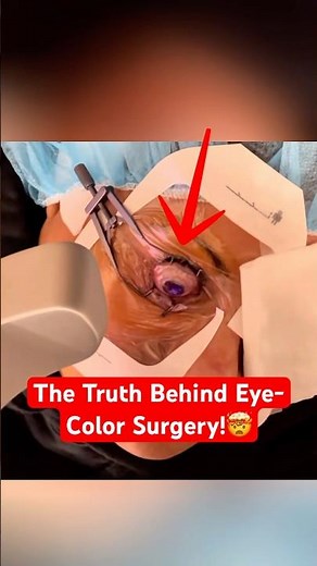 The Laser That Can Change Eye Color