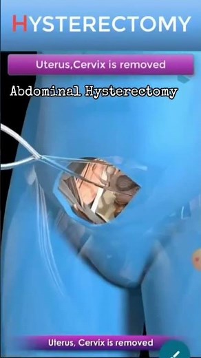 total abdominal hysterectomy procedure