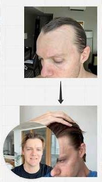 How I reversed my hair loss