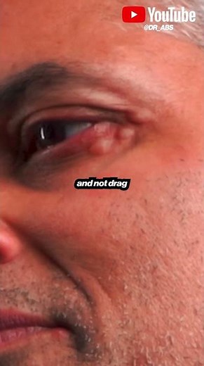 How To Inject The Under Eyes