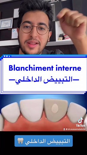 Internal Bleaching for Teeth - Understanding the Process