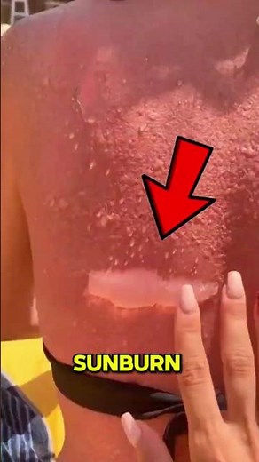 Got Sunburned Never Peel Your Skin! 😱 Here’s Why