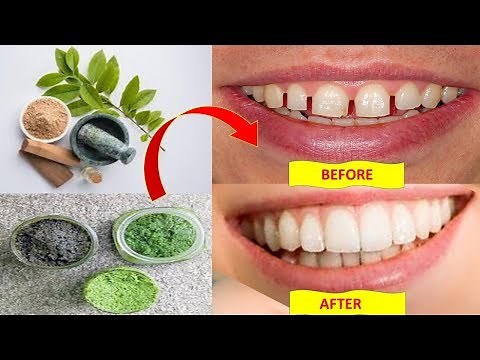 How to fix gap between teeth naturally at home without braces - Health Pavilion BRIGHT SIDE
