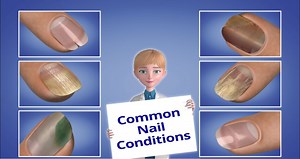 Introduction to Nail Conditions - NailKnowledge