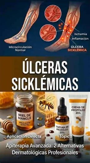 Sickle Cell Ulcers: 2 Powerful Apitherapy Remedies 🐝 #naturalhealth #health #anemia #apitherapy