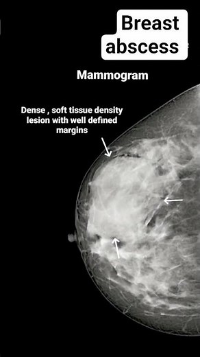 Breast abscess on ultrasound #radiology #ultrasound