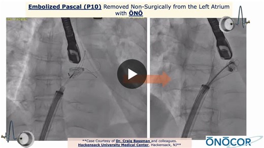 ŌNŌ helps again…Non-surgical removal of an embolized Edwards Pascal (P10) with help from ŌNŌ!Cōngratulatiōns to Dr. Craig Basman and colleagues at Hackensack University Medical Center… | Matthew Gillespie
