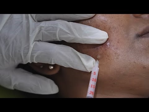 Glutathione Injections for body whitening