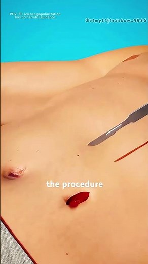 How a colostomy bag works (3D animation) #theflash #healthyparenting #science #3dmodeling