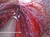 Laparoscopic Heller Myotomy with Fundoplication for Achalasia • Video • MEDtube.net