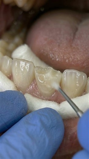 Composite Tooth Restoration | Front Tooth Aesthetic Repair