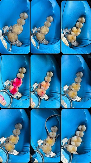 Upper Molar & Premolar Composite Restoration | Smile Rebuilt
