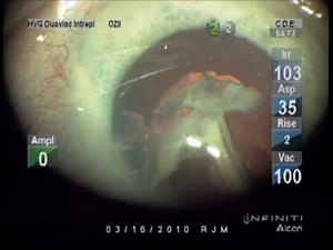Mature cataract phacoemulsification: Crater Divide and Conquer with Downslope Sculpting