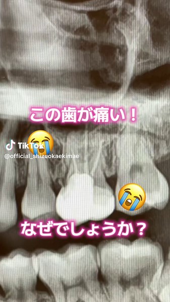 上顎洞炎と歯性上顎洞炎の痛みの原因
