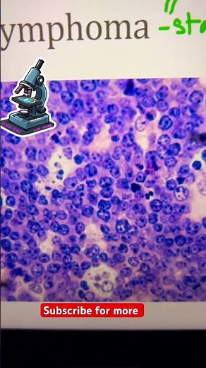 🔬 How to Identify Burkitt Lymphoma Under the Microscope | Pathology Explained