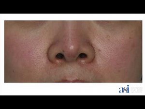 Nasal Flare