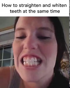 6.2M views · 3.2K reactions | ⚡FLASH SALE: $19 starter kit when you straighten your teeth with Candid. Ends soon. | Candid | Facebook