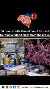 "MIT engineers have created a new robotic thread that can move through the brain's tiny blood vessels. Guided by magnets, this thin, flexible robot could help safely remove blood clots and prevent strokes. Its special design allows it to reach areas that were hard to access before, offering new possibilities in brain surgery. This breakthrough in medical robotics could lead to safer, less invasive treatments for serious conditions. Disclaimer: This is for information only. All credits to the ori