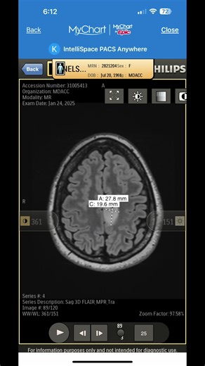 My Journey with Brain Cancer: A Year of Hope