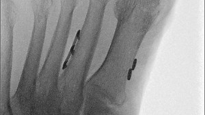 Adjunct Fixation With the Knotless Mini TightRope® System for Hallux Valgus Correction