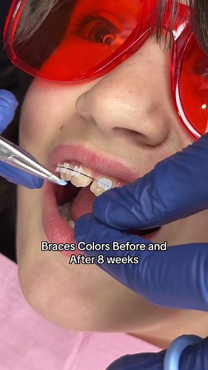 Clear, Sky Blue, Black, and Teal Before and After 8 weeks #bracescolors #braces