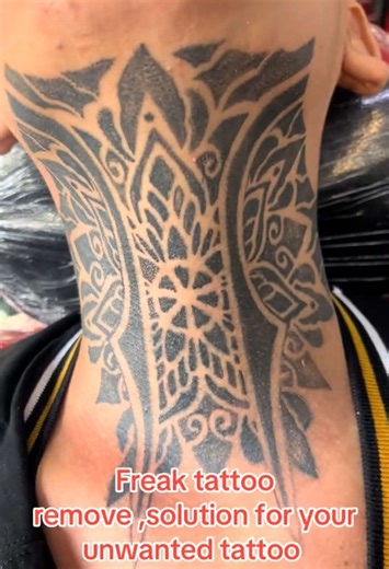 Effective Tattoo Removal Solutions with Picoway Laser