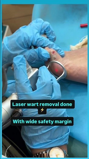 Plantar Wart Removal by Laser | Foot Wart Treatment | No Bleeding| Dr Ashima Goel MD Dermatologist