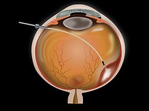 A Magnetically Navigated Microcannula for Subretinal Injections