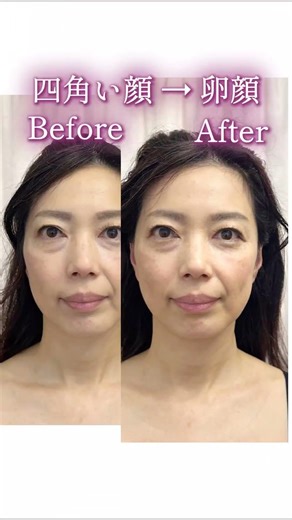 【50代】顔の左右差と長さ、たるみが気になってきた方へ #美容 #たるみ #美容整形 #左右差 #歯 #口角 #中顔面短縮 #小顔 #50代