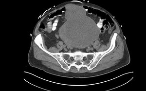 060 （起于脐尿管的胃肠道间质瘤，GIST）Gastrointestinal stromal tumor arising from the urachus