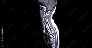 MRI of C-spine or magnetic resonance image of cervical spine sagittal view for diagnosis spondylosis and compression fracture.