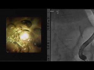 Tips and tricks for endoscopic transpapillary gallbladder drainage