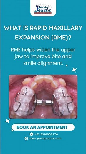 Rapid Maxillary Expansion