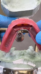 Upper and Lower Metal Mesh Try-In that clasps to the remaining teeth! Case from Dr. Joseph F. Rigg, DDS in South Dakota! | Luke Kahng