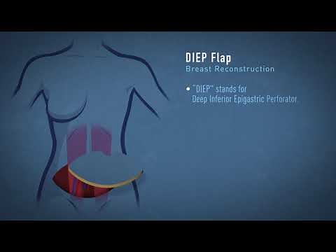 DIEP Flap Breast Reconstruction Animation