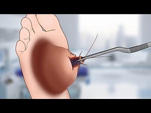 ASMR Remove Cockroach from infected foot Cyst animation