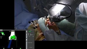 Functional Knee Positioning with Mako Total Knee