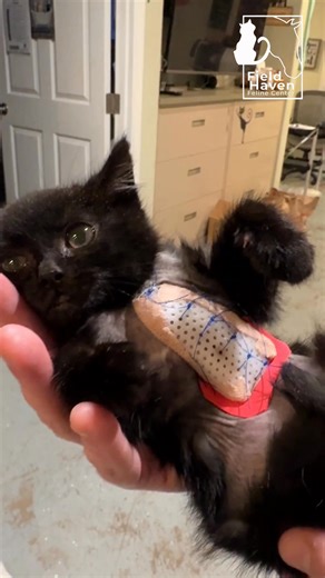 Wonder Woman! 💪 Orage is showing off her chest "shield" which is actually a device to hold her concave sternum in the proper position so it can grow correctly. The pectus excavatum causes her sternum to press on her heart and lungs. The shield is placed on the skin over the sternum. Sutures are pushed through the holes the woven down under the sternum and up through holes on the other side. This pulls the sternum up and into the proper place. The shield will stay in place for a number of weeks 