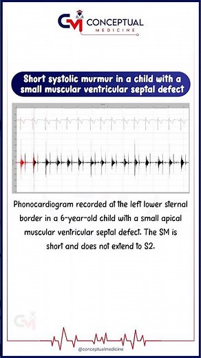 ❤️ Short systolic murmur in a child with a small muscular VSD