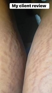 56K views · 537 reactions | Did you see this review? One of our amazing clients just shared her results after using our product and it’s too beautiful not to share!She was patient, consistent, and applied the product just the way we recommend. And look at the transformation she experienced! .. price : 30$… call ..+231886404864 #skincaregoals #familybusiness #skincaretips #antiagingskincare #skincaregoals #BeforeAndAfter | Rozay Organic Skincare | Facebook