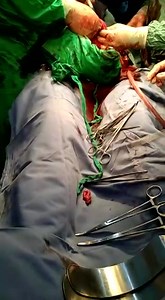 Fibroid Surgery : PARAMEDIA VIDEO : Free Download, Borrow, and Streaming : Internet Archive