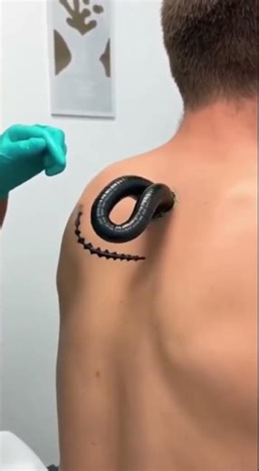 Extreme Pimple Popping & Dermatology Extractions | The Ultimate Satisfying Content(27) #short #acne