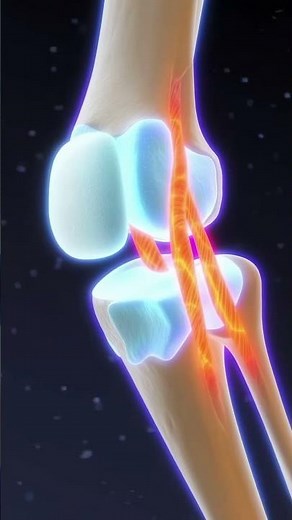Can You Ignore an ACL Tear The Truth About Knee Ligament Injuries & Early Treatment