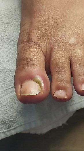Siga para mais vídeos satisfatórios.💅🏻 #unhaencravada #podologia #videossatisfatorios #ingrowntoenail #satisfying