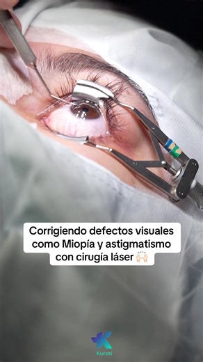 Corrección de miopía y astigmatismo con cirugía láser